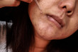 Close up photo of acne skin problem, Asian woman applying anti-ageing moisturizing lotion serum to her face, Skin Problem acne concept
