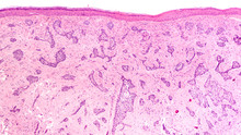 Photomicrograph Of Skin Biopsy Showing A Sclerosing (morpheaform) Basal Cell Carcinoma.