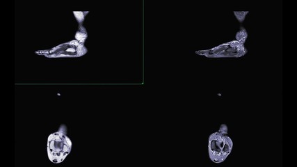 Poster - mri foot compare sagittal and axial t2 ,t1 for diagnostic tendon injury.