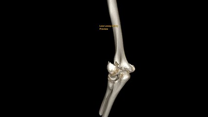 Poster - CT Elbow 3D rendering image turnaround on the screen showing fracture left humerus bone.