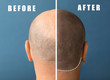 Man before and after hair loss treatment on color background