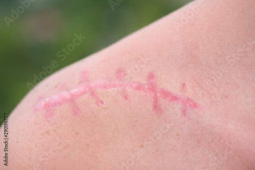 Scar Skin Wound Plastic Surgery Scarification White Skin With A Pink Surgical Scar On Shoulder Female Shoulder And Laser Scar Removal Treatment Stock Photo Adobe Stock