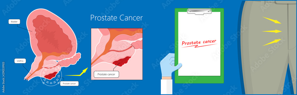 Prostatitis Test Transurethral resection of the prostate stricture urine bladder digital ...