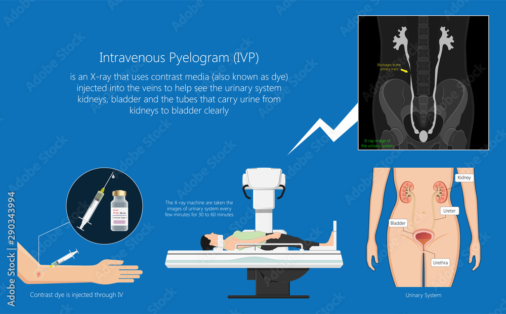 Intravenous pyelogram IVP examination x-ray for bladder kidney ureters ...
