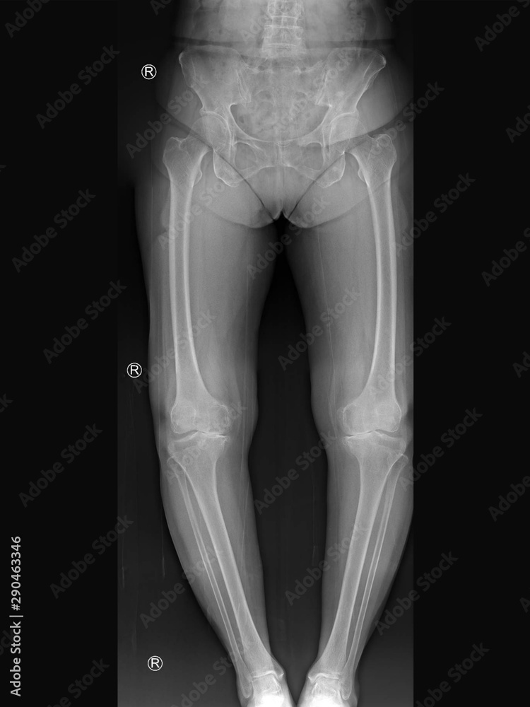 film x-ray knee radiograph showing bow leg deformity (genu varus or ...