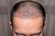 Close up view of a man's head with hair transplant surgery. Bald head of hair loss treatment.