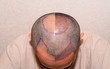 Top view of a man's head with hair transplant surgery with a receding hair line. Bald head of hair loss treatment.