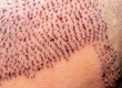 Close up hair graft transplantation with follicular unit extraction (FUE). Bald head of hair loss treatment. Selective focus.