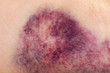 Close up of a hematoma on the arm of woman.
