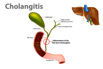 Wall Mural - Inflammation of the bile duct (Ascending cholangitis or acute cholangitis)