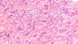Breast cancer histology (core biopsy): Microscopic image (photomicrograph) of an infiltrating (invasive) ductal carcinoma, detected by screening mammogram. H & E stain.