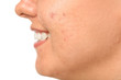 © Pixel-Shot - Young woman with acne problem on white background, closeup