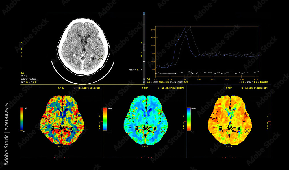 CT Brain Perfusion or CT scan image of the brain 3d rendering image ...
