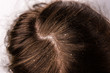 Dandruff seborrhea problem of scalp and hair treatment of peeling from allergies or lichen.