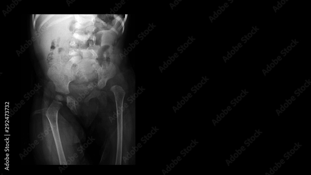 Film X ray hip radiograph show congenital developmental dysplasia of left hip(DDH) disease with hip joint subluxation. The patient has hip pain, limping and walking problem. Medical technology concept - obrazy, fototapety, plakaty 