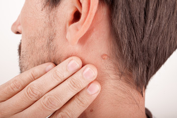 Adult man with moles on his neck