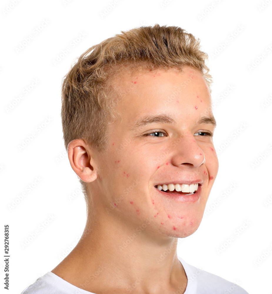 Teenage boy with acne problem on white background Stock Photo | Adobe Stock
