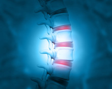 Disc Problem Of Human Spine. 3d Illustration.