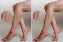 Medicine And Health. The Concept Of Female Varicose Veins. Female Legs With Vascular Stars On The Legs, With An Enlarged Picture. Before And After