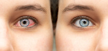 A Before And After View Of A Beautiful Caucasian Girl Who Was Suffering From Red Eye (conjunctivitis), Results Of Successful Antibiotic Eye Drops Treatment.