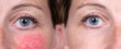 A mature caucasian woman in her early 40s shows the before and after results of successful treatment for rosacea, superficial blood vessels and rosy cheeks have diminished.