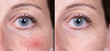 A closeup view on the blue eye of a 40 year old caucasian woman showing the before and after results of successful surgical procedure to remove the symptoms of rosacea from the upper cheek.