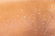 A closeup and macro view in the dry, flaky skin of a caucasian person, filling the frame with detail, dried out in need of dermatologist and moisturization.