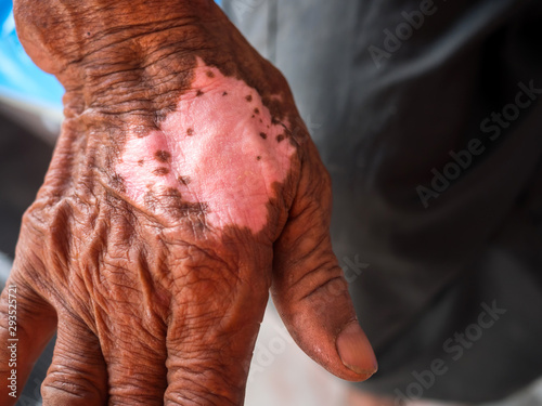 Fotografía White spotted skin disease on arms asian man