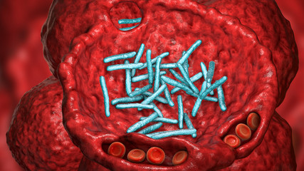 Poster - Bacterial pneumonia, medical concept. 3D illustration showing rod-shaped bacteria inside alveoli