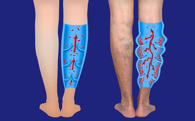 Varicose veins on a female senior legs. The structure of normal and varicose veins.