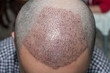 Top view of a man's head with hair transplant surgery. Bald head of hair loss treatment.