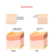 Cross-section of skin layers before and after Exfoliation