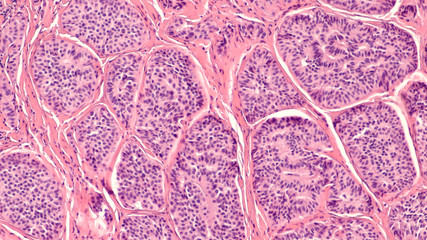 Wall Mural - Photomicrograph of a carcinoid tumor, a type of neuroendocrine tumor (NET), which presented as a colon polyp during routine colonoscopy.  Spread to liver can cause symptoms of carcinoid syndrome.