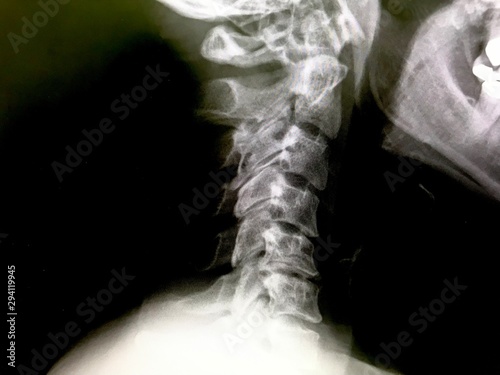 首の骨が逆にカーブしているレントゲン写真 Stock 写真 Adobe Stock