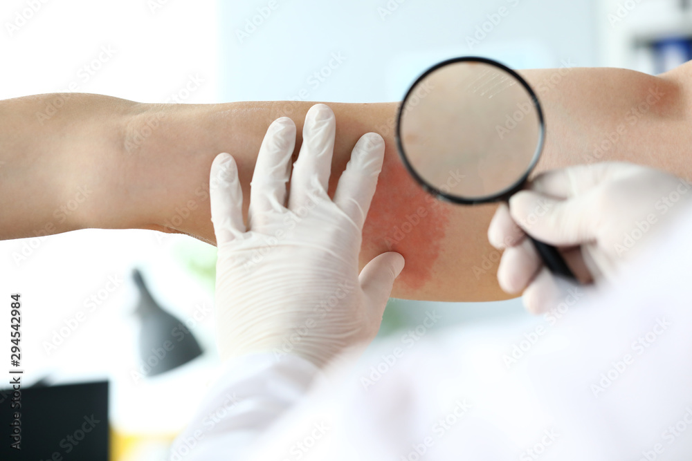 Focus on special dermatological magnifying glass used to inspect red rush spreading on bad skin of suffering patient. Dermatology clinic advertisement concept. Blurred background - obrazy, fototapety, plakaty 