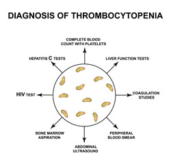 Diagnosis of thrombocytopenia. Lowering platelets in the blood. Infographics. Vector illustration on isolated background.