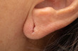 Earlobe with former piercing hole mark close up
