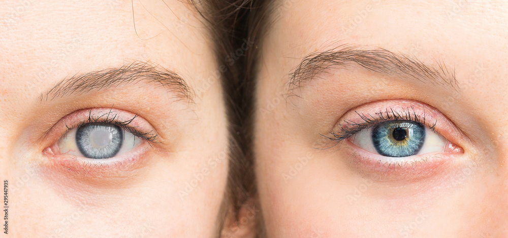Person with white pupil and healthy eye comparison close up Adobe Stock