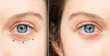 © Alessandro Grandini - Eye bags, skin problem correction procedure and treatment