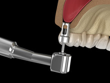 Sinus Lift Surgery - Creating An Access To The Sinus. 3D Illustration