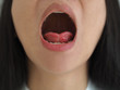 ankyloglossia in asian woman and cause of an unusually short of tissue tethers the bottom of the tongue to the floor of the mouth on isolated white background