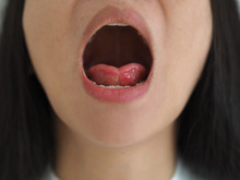 Ankyloglossia In Asian Woman And Cause Of An Unusually Short Of Tissue Tethers The Bottom Of The Tongue To The Floor Of The Mouth On Isolated White Background