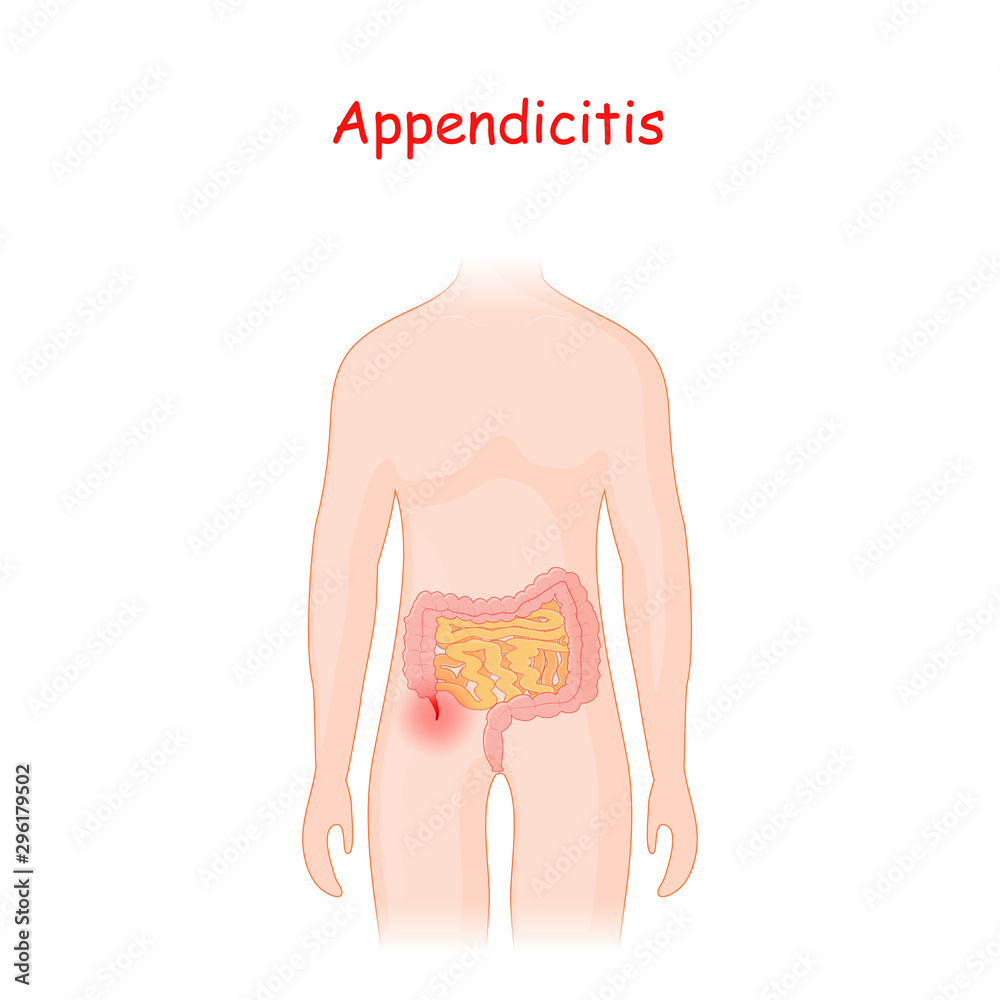 appendicitis. human silhouette with a colon, small intestine and an ...