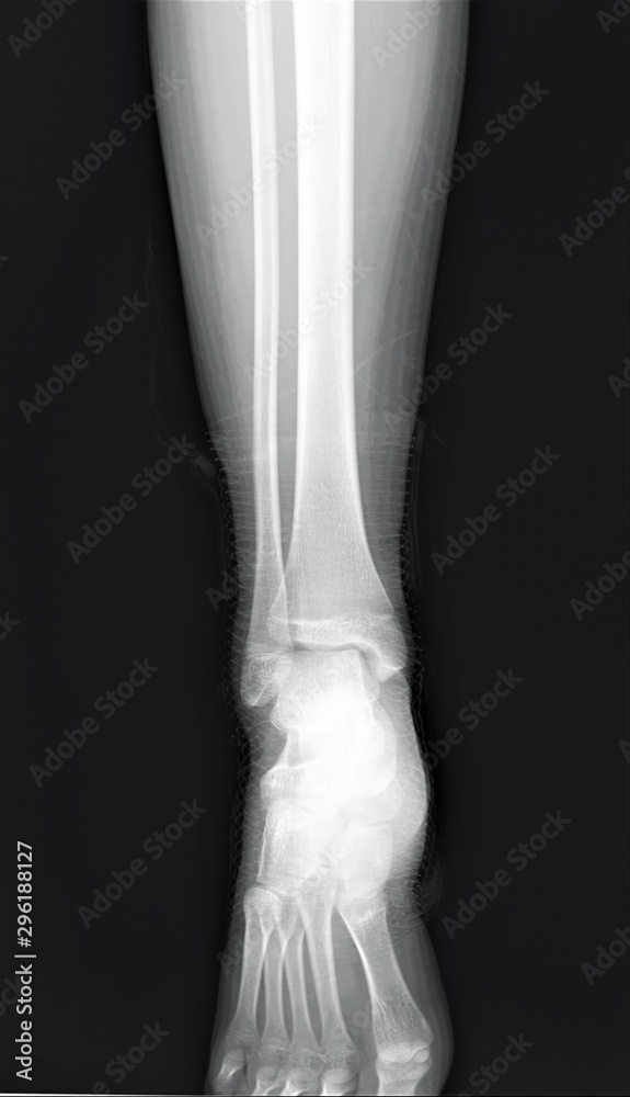 normal radiograph of the ankle joint Stock Photo | Adobe Stock