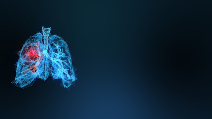 3d rendered illustration of lung cancer 3D illustration