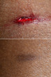© Alessandro Grandini - Superficial wound before and after a connective tissue treatment