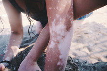 Close Up Of Woman's Limbs With Vitiligo 