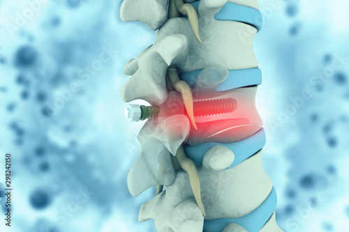 Cuadros en Lienzo spinal column with implant. screw placement. 3d illustration