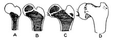 Ossification Of The Femur And The Condition Of Coxa Vara, Vintage Illustration.