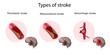 Types of stroke. Thrombotic, Atherosclerosis, Hemorrhagic stroke. Medical illustration.